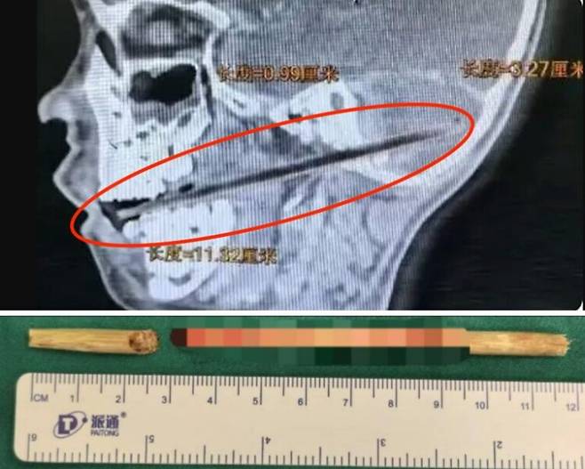 중국의 한 소년이 막대사탕을 입에 문 채로 넘어져 끔찍한 사고를 당했다. [사진='광저우데일리' 보도내용]