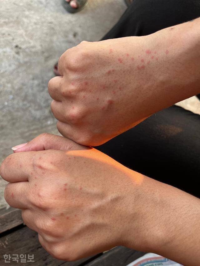 2일 만달레이 시민 피요가 대피소 생활을 하면서 야외에서 취침해 모기에 잔뜩 물린 손을 기자에게 보여주고 있다. 만달레이(미얀마)=허경주 특파원