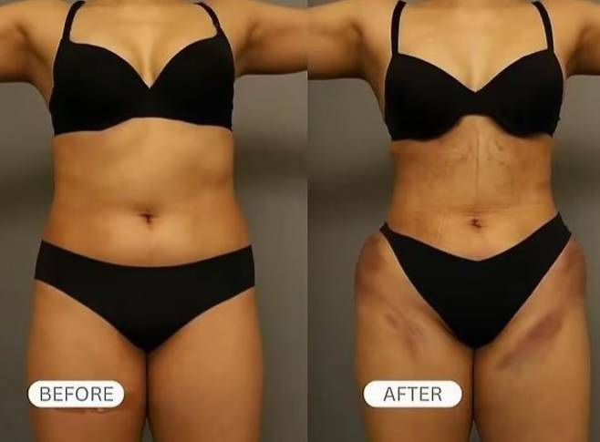 갈비뼈 제거 수술을 받은 여성의 전과 후의 모습/사진=데일리메일