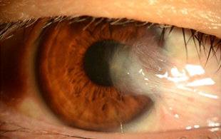 중증 익상편이 발생한 환자의 눈. 하얀 막이 동공 주변까지 덮고 있다.  중앙대병원 제공