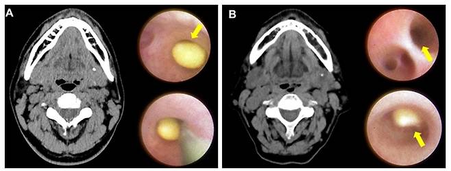 타석이 손으로 만져지지 않는 '고난도 턱밑샘 타석증'을 치료할 때 내시경 시술이 가장 효과적이라는 연구 결과가 나왔다. /사진=해당 논문