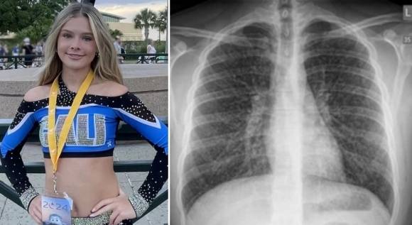 미국 뉴저지에 사는 17세 여고생 브리앤 캘런(왼쪽)은 3년간 전자담배를 사용한 뒤 치명적 폐 질환 진단을 받았다. 오른쪽은 팝콘 폐 질환 환자의 폐 자료사진