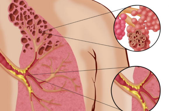 ‘팝콘 폐’ 질환을 나타낸 이미지. 자료사진