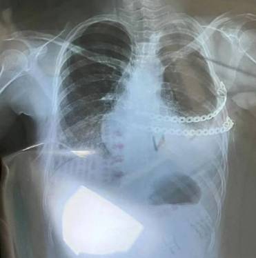 쉬안이 인공 가슴을 장착하고 찍은 X-Ray.