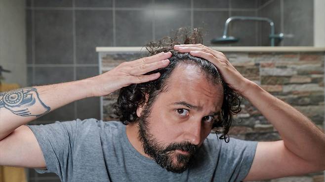 탈모는 유전적인 원인으로 발생하기도 한다