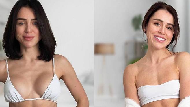 유방 보형물 제거 및 입술 필러 제거 전후의 카테리나 크루프키나