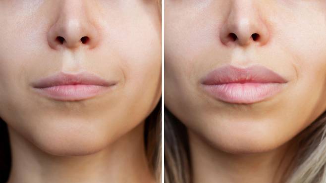 전문가들은 입술 확대와 같은 미용 시술의 인기가 수년간 높아진 후 이제 환자들이 더 섬세하고 자연스러운 시술을 선택하고 있다고 말한다