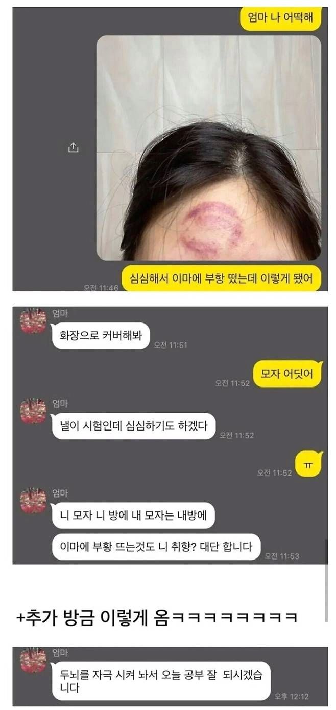 image.png 심심해서 이마에 부항 뜬 여자