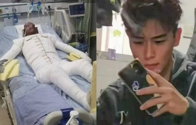 전기 자전거 배터리가 폭발하는 비극적 사고로 인생이 바뀌어버린 22세 중국 남성의 사연이 소개됐다. [사진=SNS]