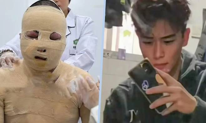 중국의 한 22세 청년이 룸메이트가 타고 다니는 전기자전거 배터리로 폭발로 심각한 화상을 입었다 [사진출처 = SCMP]