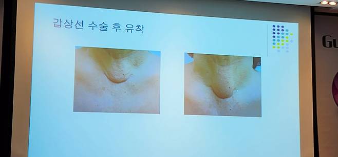 강상욱 세브란스병원 내분비외과 교수는 이날 '갑상샘암 수술 후 목 부위가 유착된 실제 사례'를 공유하며, 유착방지제 사용의 중요성을 강조했다. /사진=정심교 기자