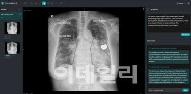 딥시크를 활용한 딥노이드 흉부 엑스레이 생성형AI가 판독문을 제시한 모습 (사진=딥노이드)