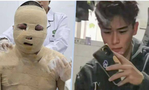 친구가 집 안에서 충전한 전기 자전거 배터리가 폭발해 몸 90%에 심한 화상을 입은 중국 남성 두준하오. 홍콩 사우스차이나모닝포스트(SCMP) 캡처