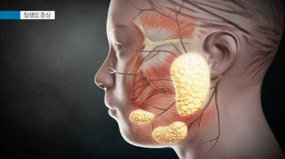 주타액선, 소타액선을 막론하고 침샘에서 발생하는 악성종양을 의미하는 침샘암은 우리에게 다른 암보다는 생소하다. [사진=EBS]