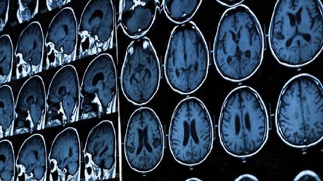 뇌 MRI 사진. /영 카디프대