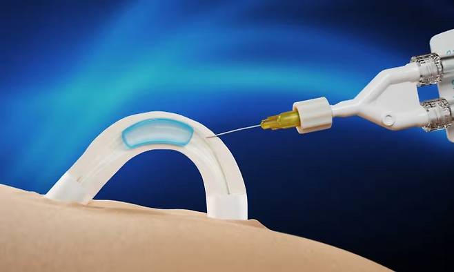 최초침습시술을 이용해 새로운 피임 기술인 ‘아담’을 적용하고 있는 이미지. 콘트랄린 제공.