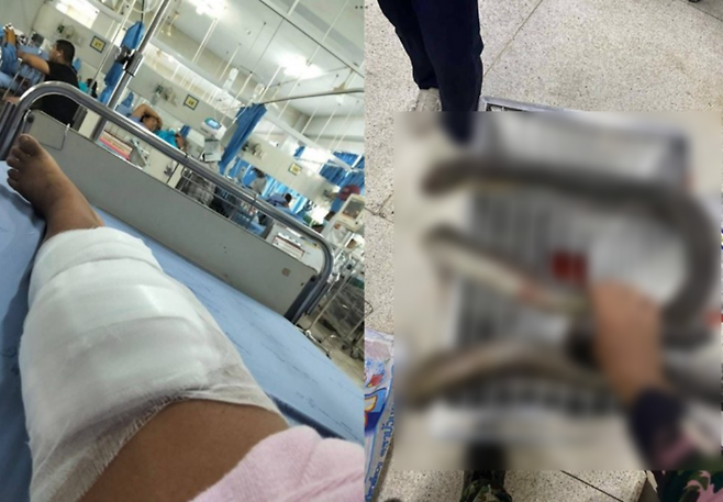 킹코브라의 공격을 받고 맨손으로 제압해 살아남은 태국 여성. 치료를 받은 다리와 그가 들고 온 뱀 사체. 사진=페이스북(Kannika Rueangsa) 캡처