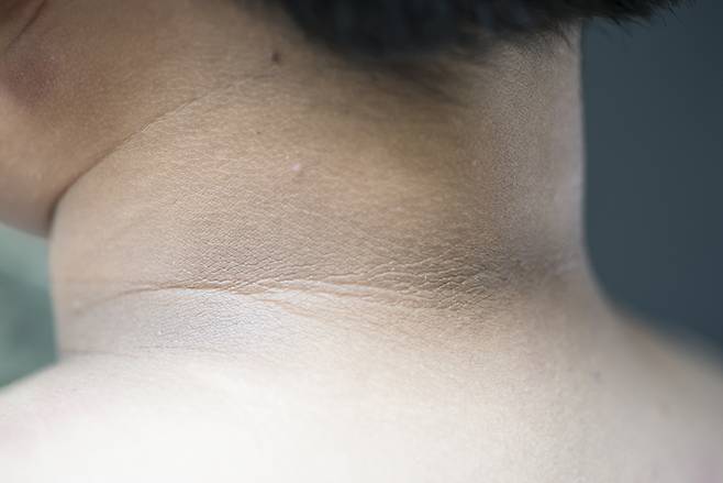 흑색가시세포증 증상으로는 목덜미 등의 피부가 검게 변하는 색소 침착&nbsp;등이 있다. 게티이미지뱅크