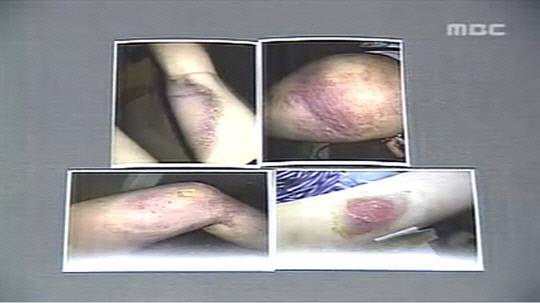 2006년 '청주 고데기 학폭 사건' 피해 여중생 A(당시 3학년) 양이 가해 학생들로부터 폭행을 당해 생긴 상처. MBC보도화면 캡처.