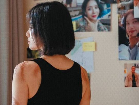넷플릭스 드라마 '더 글로리'에서 고데기 학폭으로 인해 주인공 문동은(송혜교)의 몸에 남은 화상 자국들. 넷플릭스.
