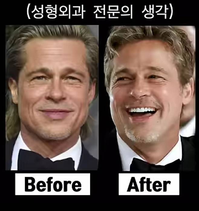 1000039180.jpg 성형외과 의사도 극찬한 1억 6천짜리 성형 받았다는 브래드피트 근황 ㄷㄷㄷ...jpg