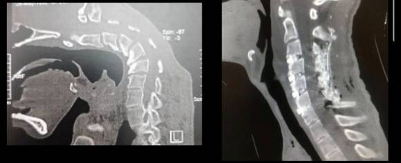 약물 중독으로 머리떨굼증후군(Dropped Head Syndrome, DHS)과 경추후만증(Cervical Kyphoscoliosis, CKS)을 얻은 20대 남성의 엑스레이 사진. 이란 이스파한의과대학 신경외과 자료
