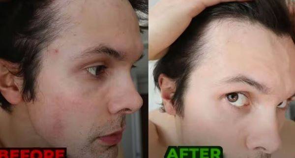 윌 테니슨이 7일 동안 천연식품을 먹기 전(왼)과 후(오)의 피부/사진=유튜브 채널 ‘Will Tennyson’ 캡처