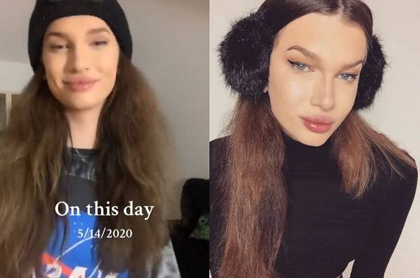 시술 전 더슨의 모습/사진=졸린 더슨 틱톡 계정, 더 선