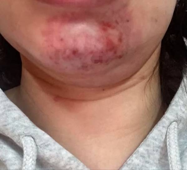 영국의 한 여성이 필러 시술을 받은 후 혈관이 막히는 부작용을 겪은 사연이 공개됐다./사진=데일리메일