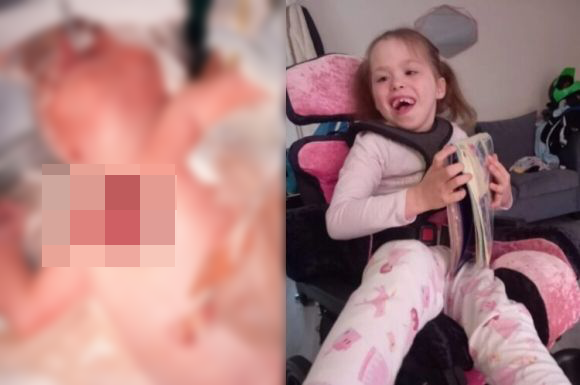 심장이 몸 밖으로 나온 채 태어난 소녀가 7년간의 기다림 끝에 흉부 재건 수술에 성공했다. 영국 레스터 대학병원