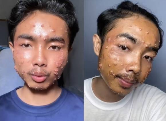 중고 매장에서 산 옷을 세탁하지 않고 착용해 ‘전염성 연속종’에 걸렸다고 주장한 틱톡커. 틱톡 캡처