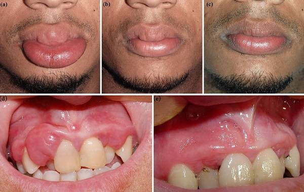부종으로 인해 입술과 입안이 부은 멜커슨 로젠탈 증후군 환자/사진=Journal of Cutaneous Medicine and Surgery