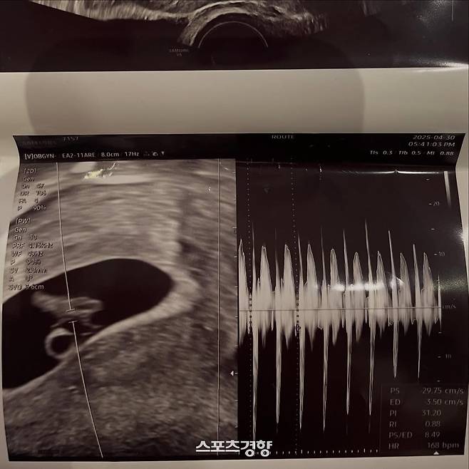 서민재가 공개한 초음파 사진. 본인 인스타그램 계정