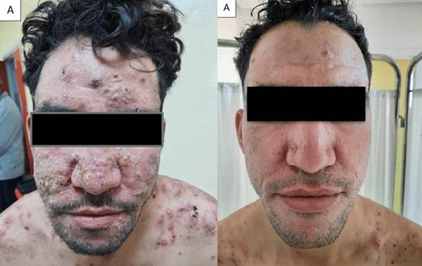 급성 여드름을 겪던 A씨의 치료 전 사진(왼쪽)과 치료 6개월 후 모습(오른쪽)./사진=큐레우스