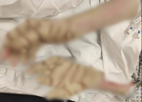 옴에 의해 과각화증(피부 각질층이 두꺼워지는 증상)​이 생겨 마치 흰 장갑을 낀 것같이 변한 환자의 손./사진=큐레우스