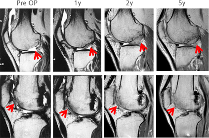 바이오솔루션의 ‘카티라이프’ 투여 후 무릎 연골 재생 경과. 사진 제공=바이오솔루션