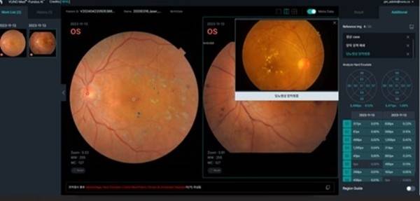 VUNO Med®-Fundus AI 사진 출처 : 홈페이지 캡처