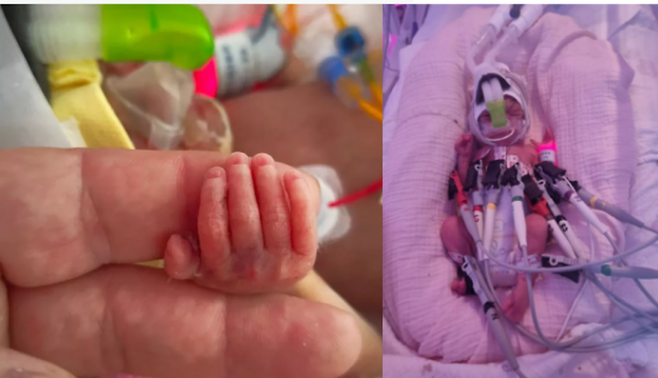 예정일 보다 15주 빨리 태어난 아기, 체중 820g에 아빠 손바닥만한 크기로 세상에 나온 아기의 사연이 전해졌다. 아기의 손은 아빠의 손가락 끝마디 만큼 작았다. [사진=고펀드미미]