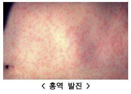 홍역 발진.[사진 = 질병관리청]