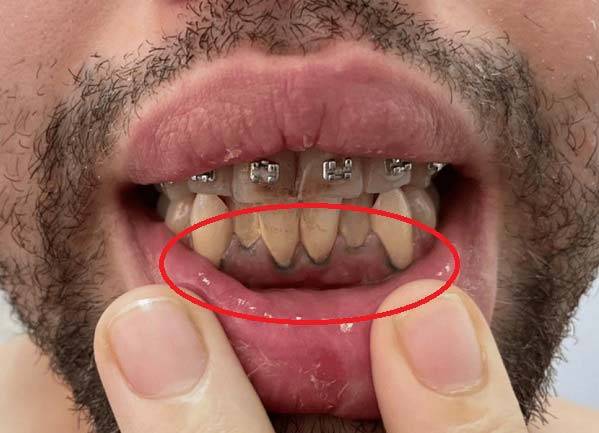 납 중독에 의해 잇몸 가장자리가 파랗게 변한 모습./사진=큐레우스