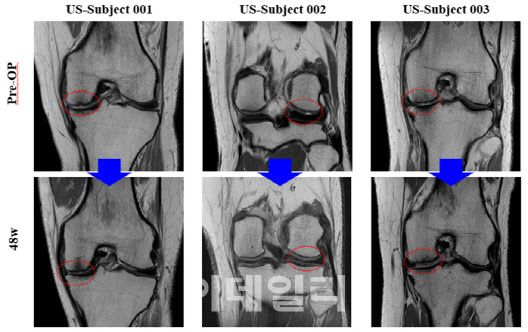 Preoperative and postoperative MRI images of a U.S. patient show that the cartilage defect was filled after 48 weeks of treatment. (Provided by Biosolution)