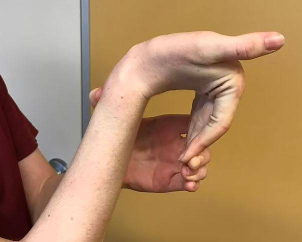 손가락이 뒤로 180도 이상 꺾이고, 피부가 종이처럼 약하다면 '엘러스 단로스 증후군'을 의심해 봐야 한다./사진=Queensland Rheumatology 제공