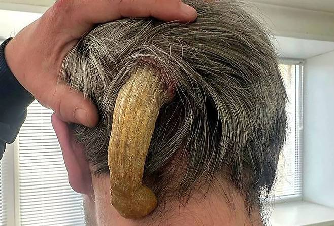 러시아 남성 뒤통수에 자라난 뿔 [출처='미러' 캡처]