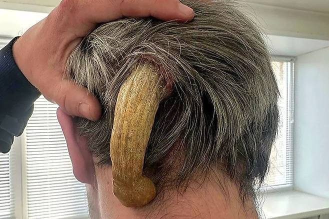 러시아 30세 남성 뒤통수에 자란 뿔(피각). 사진=City Hospital 5 /east2west news