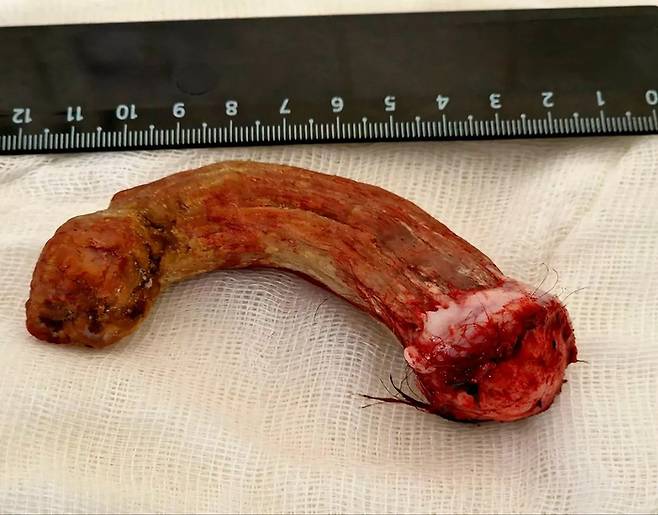 러시아 30세 남성 뒤통수에 자란 뿔(피각). 사진=City Hospital 5 /east2west news