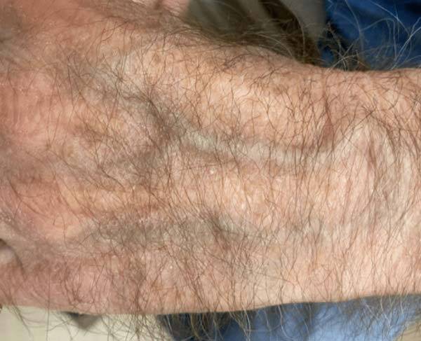 신세포암으로 인한 다모증으로 비정상적으로 길어진 손등의 털./사진=큐레우스