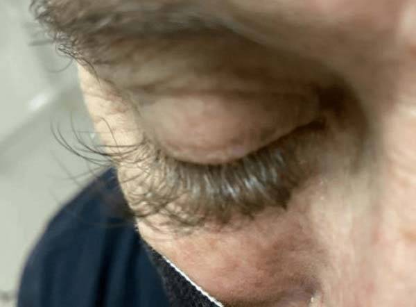 신세포암으로 인한 다모증으로 비정상적으로 길어진 속눈썹./사진=큐레우스