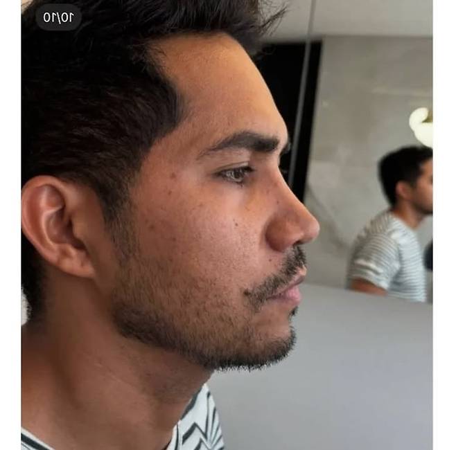 5E80DD11-5AB5-4EB7-9A0C-163DD39CEFCC.jpeg 레전드 코 성형수술. jpg