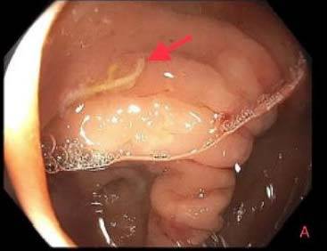 미국 70대 여성이 2년간 복통에 시달렸고, 결국 대장에서 기생충이 발견됐다./사진=Journal of Investigative Medicine High Impact Case Reports