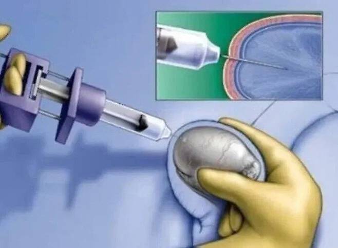 0504fbe0f48836b22235376e2441807d.webp.ren.jpg 의외로 실존한다는 비뇨기과 정액검사 방법 ㄷㄷㄷ.jpg